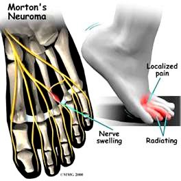 What is Morton’s Neuroma Anyway?